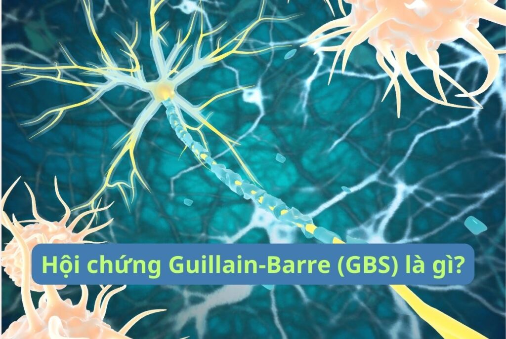 Hội chứng Guillain-Barre (GBS) là gì